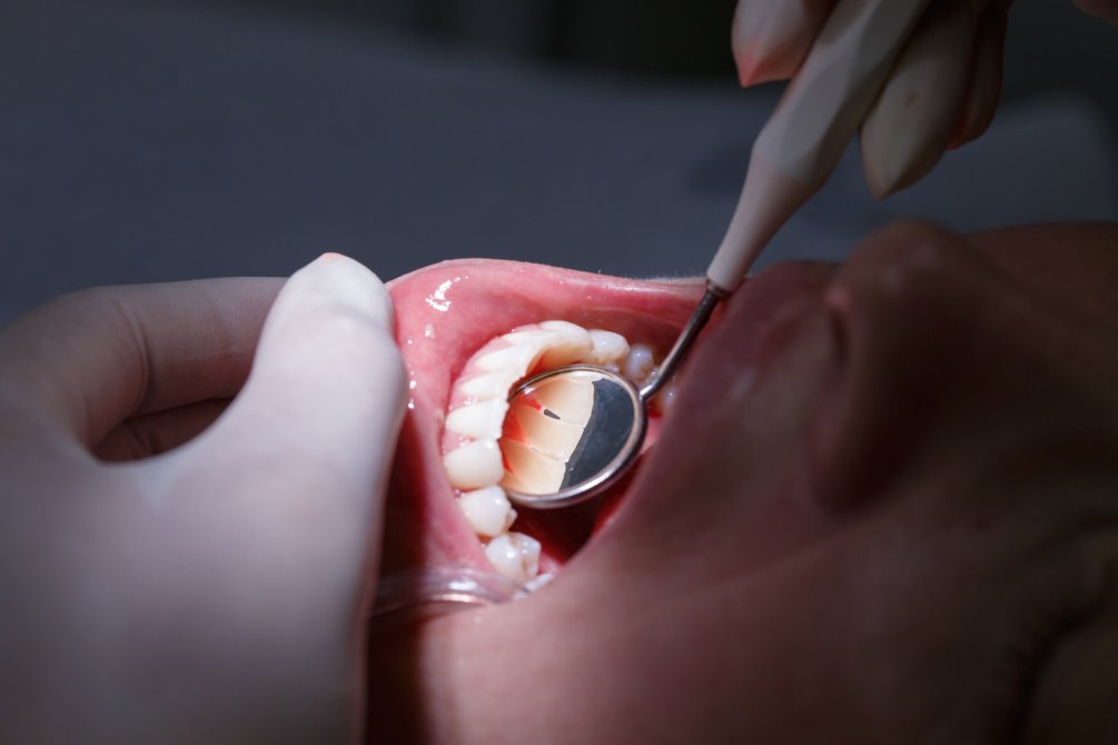 Dentiste soins des gencives - Clinique Dentaire Dr. Karam